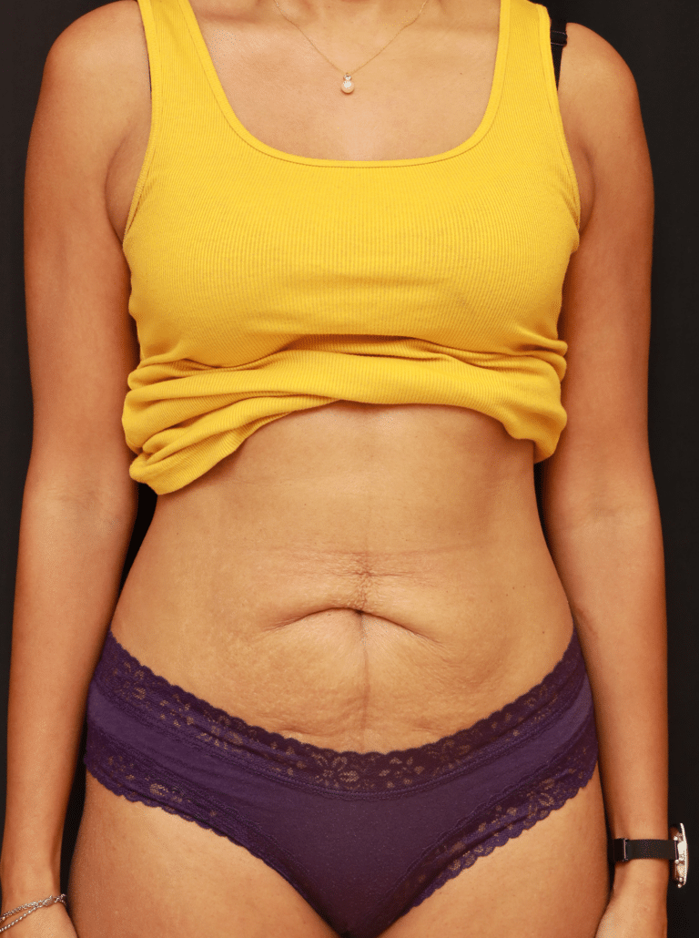 Before Image: Tummy Tuck (3 Months Post-op) - front