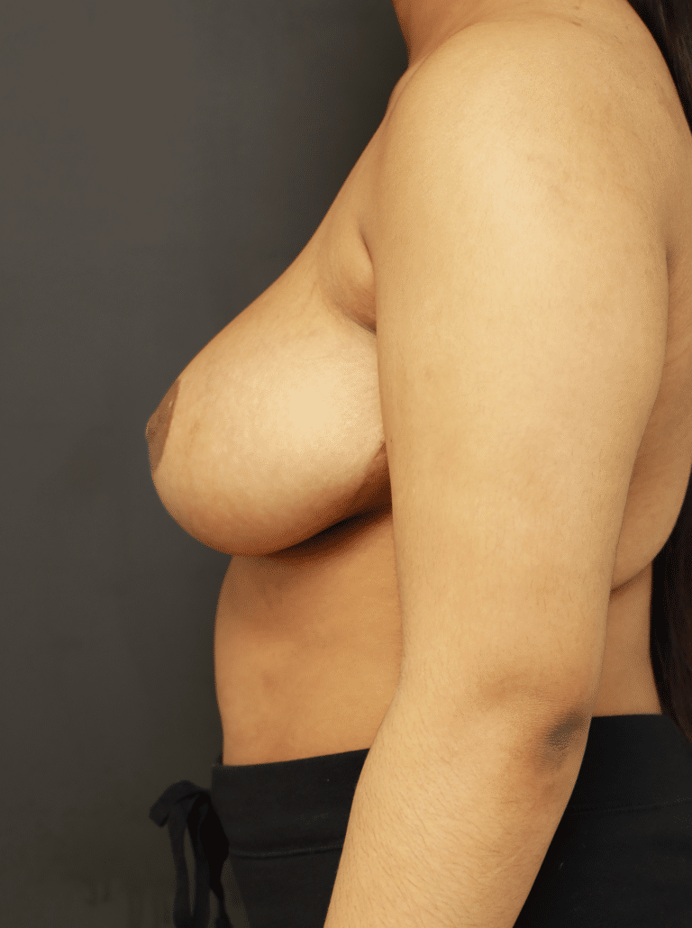 After Image: Breast Reduction (3 Months Post-op) - left-side