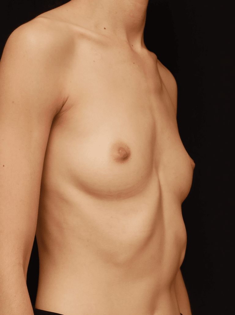 Before Image: Breast Augmentation (1 Year Post-op) - right-front-oblique