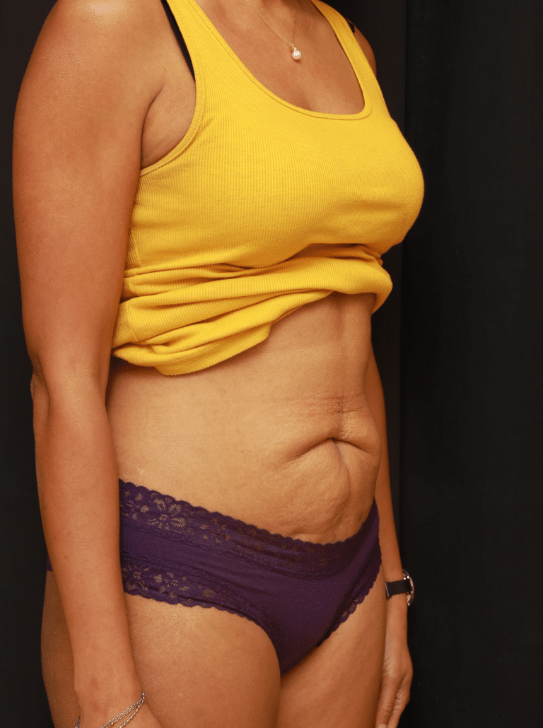 Before Image: Tummy Tuck (3 Months Post-op) - right-front-oblique