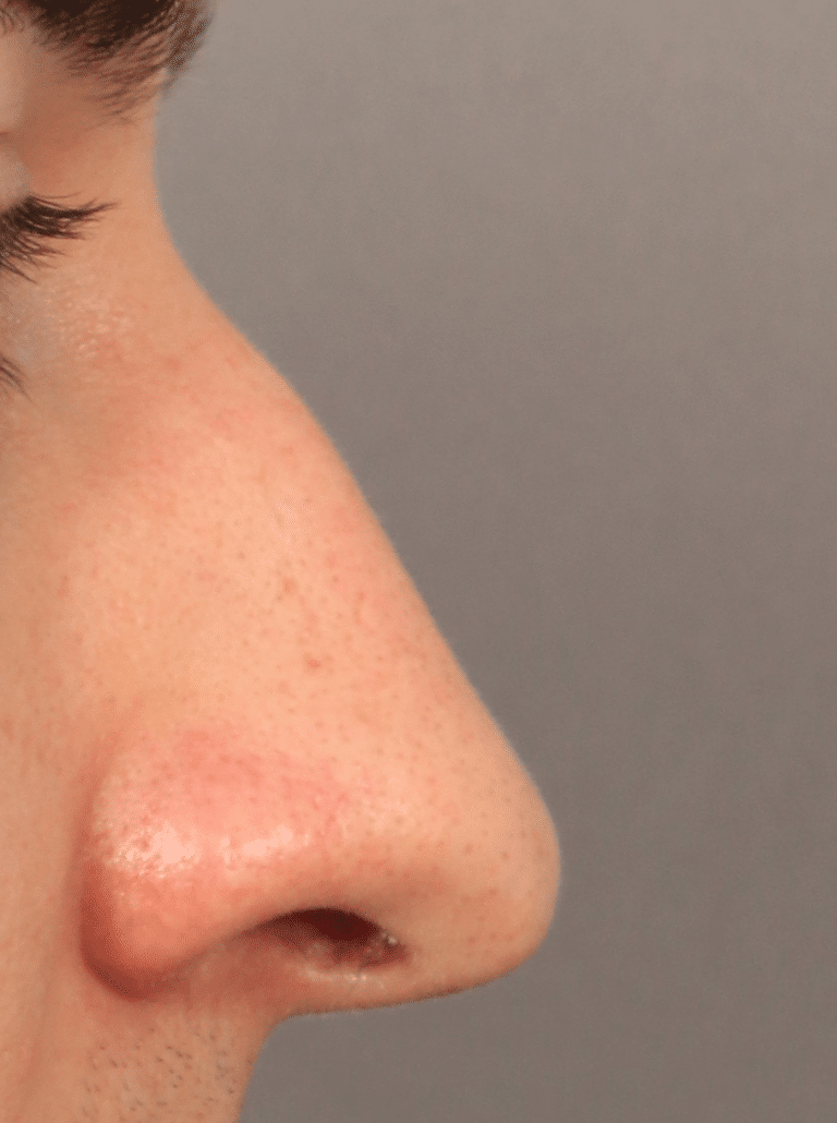 Before Image: Rhinoplasty, Septoplasty, and Alarplasty (2 Month Post-op) -