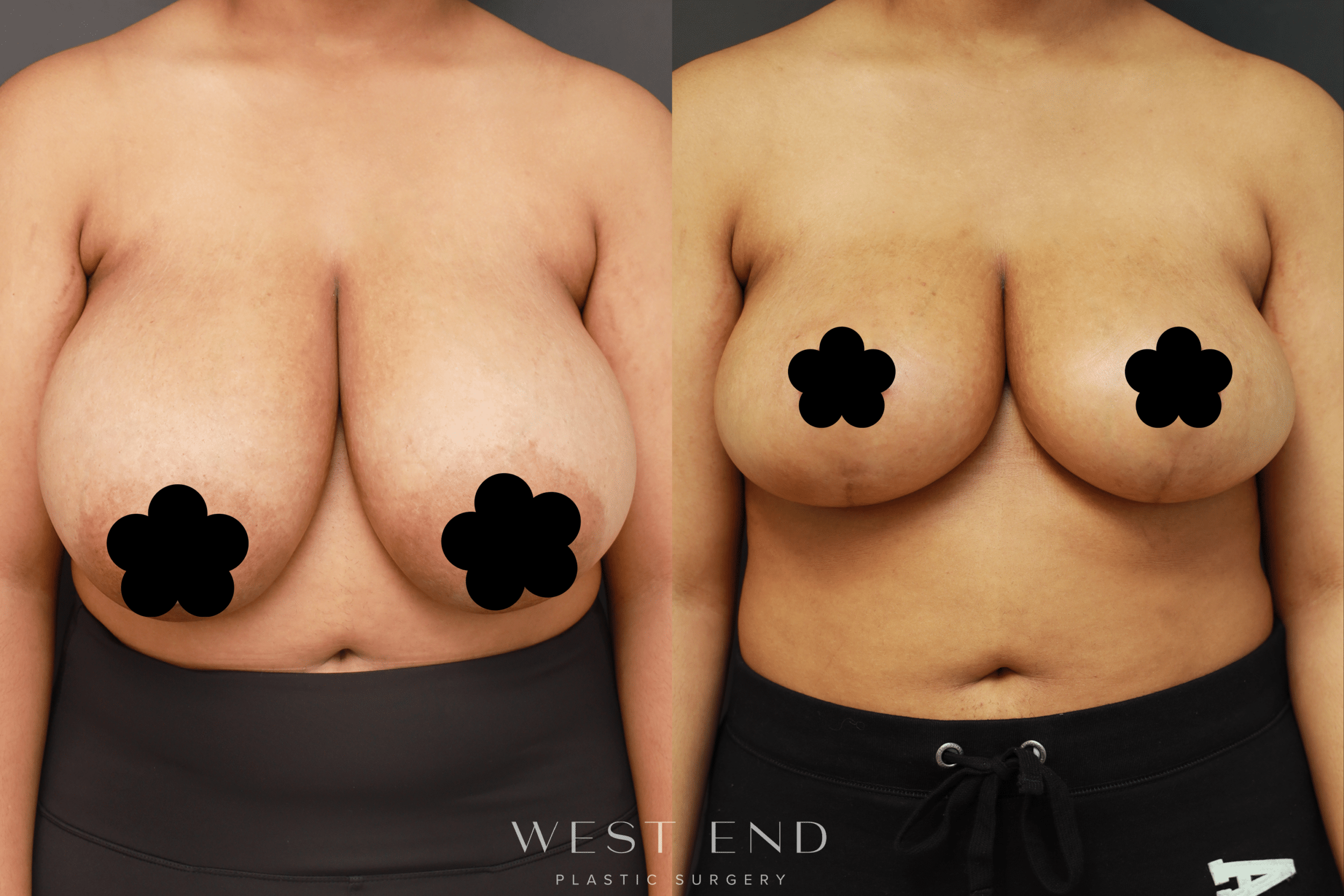 Breast Reduction Surgeon Washington DC