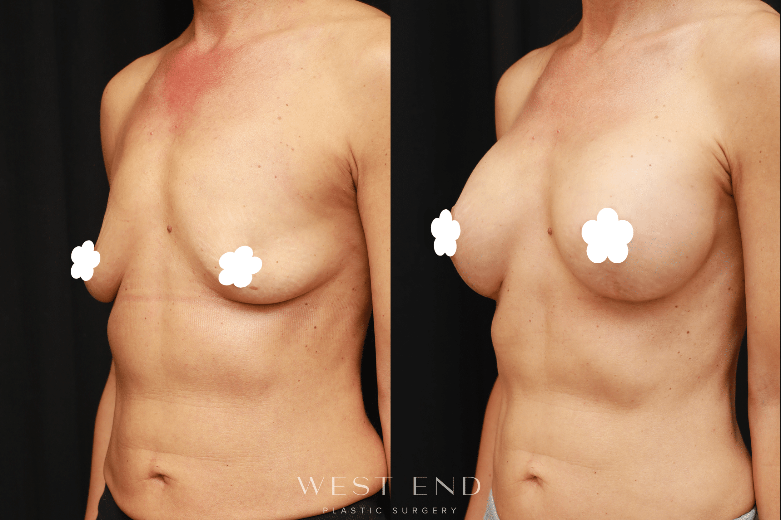 Breast Lift Cost Washington DC