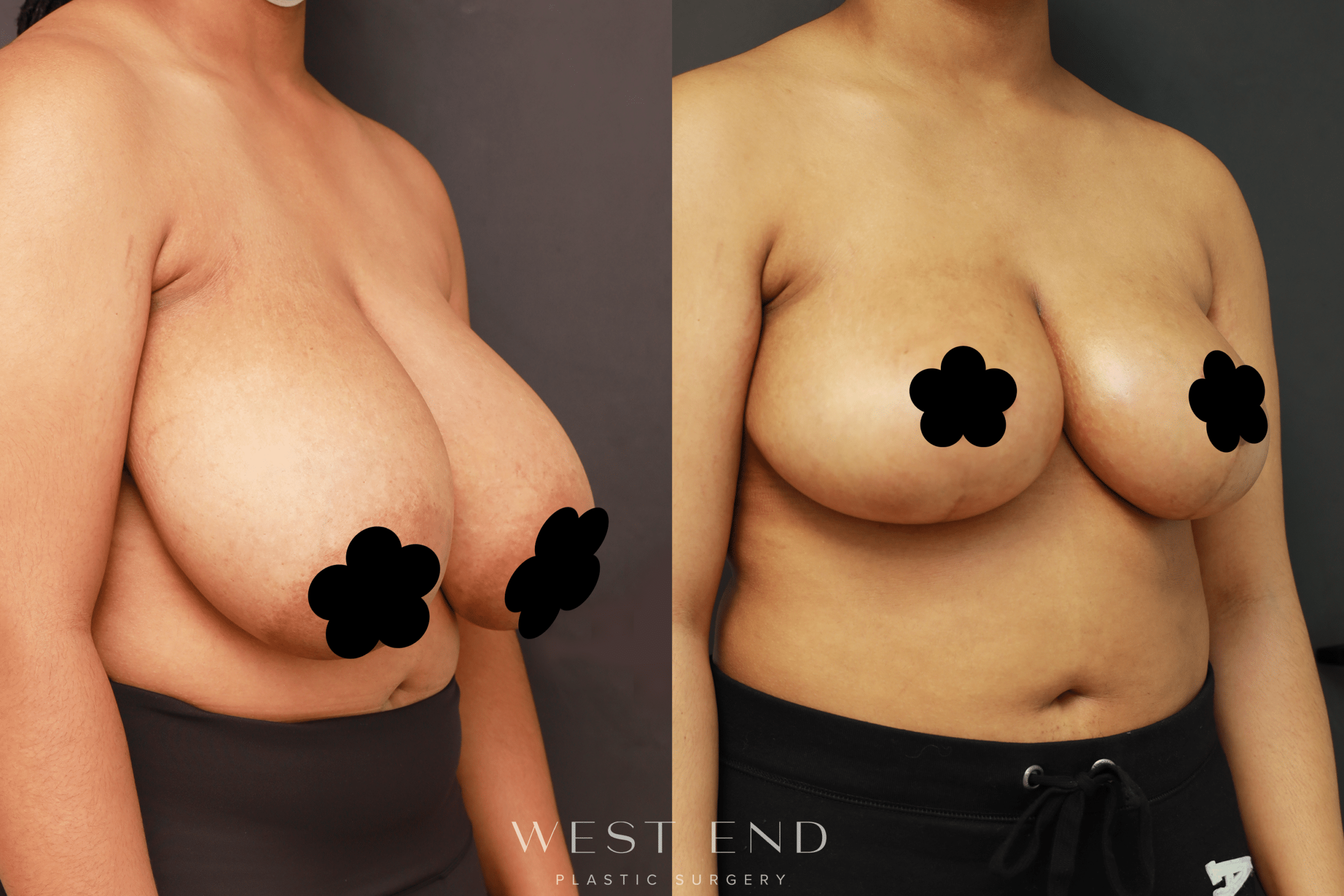 Breast Reduction Specialist Washington DC