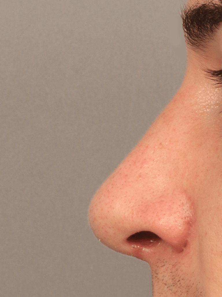 After Image: Rhinoplasty, Septoplasty, and Alarplasty (2 Month Post-op) - left-side