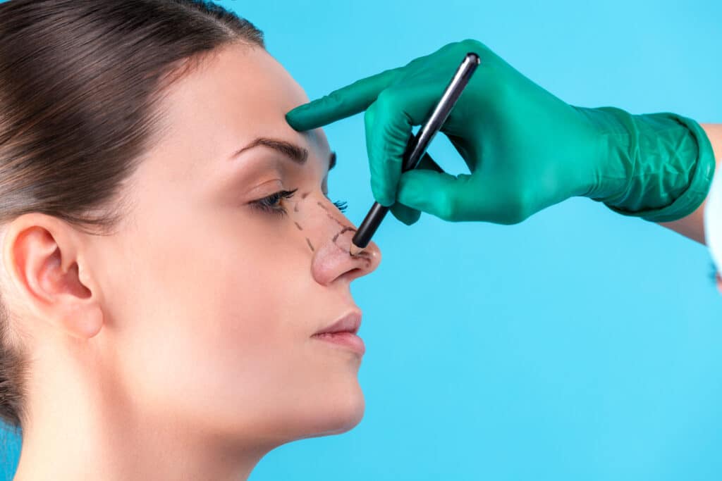 Woman being marked on by her plastic surgeon before her nasal top refinement rhinoplasty