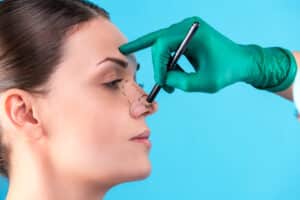 Woman being marked on by her plastic surgeon before her nasal top refinement rhinoplasty