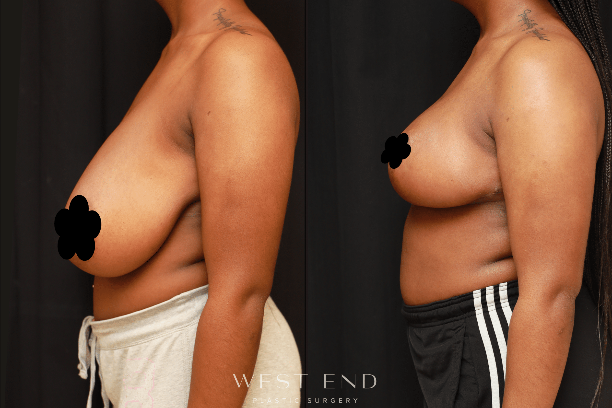 Breast Reduction Washington DC