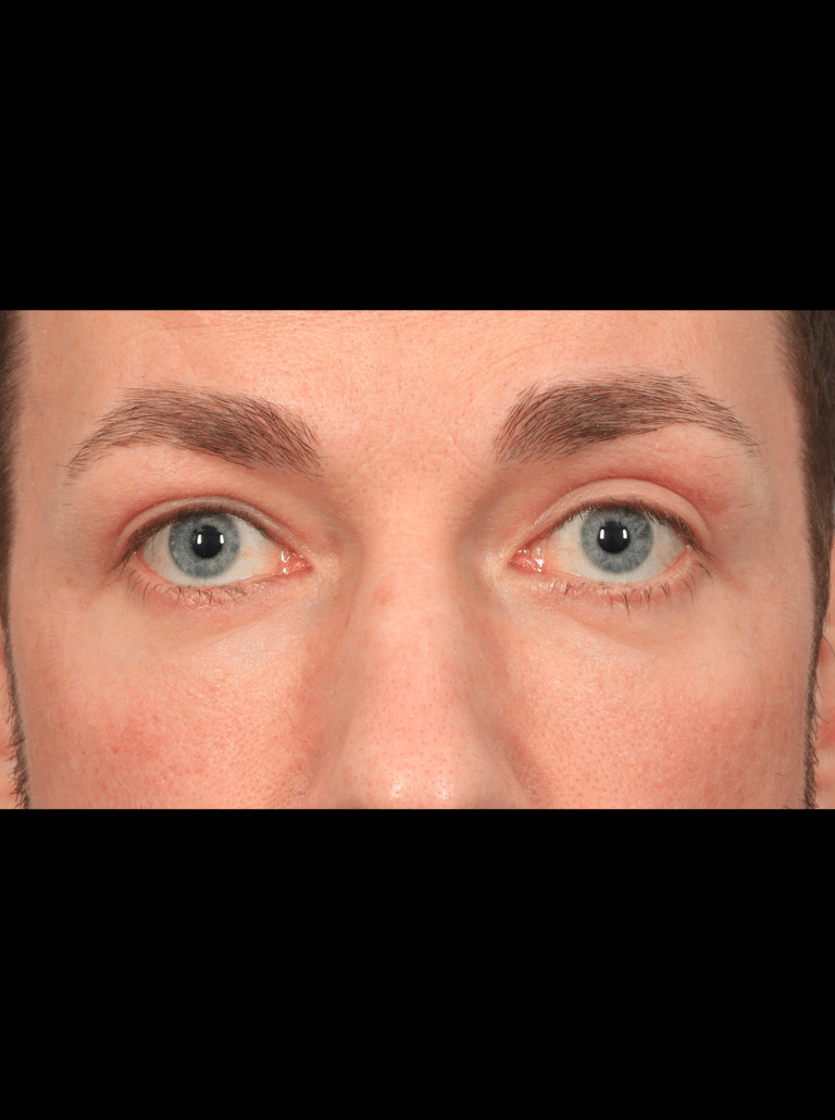 After Image: Upper & Lower Eyelid Lift (4.5 Months Post-op) - front