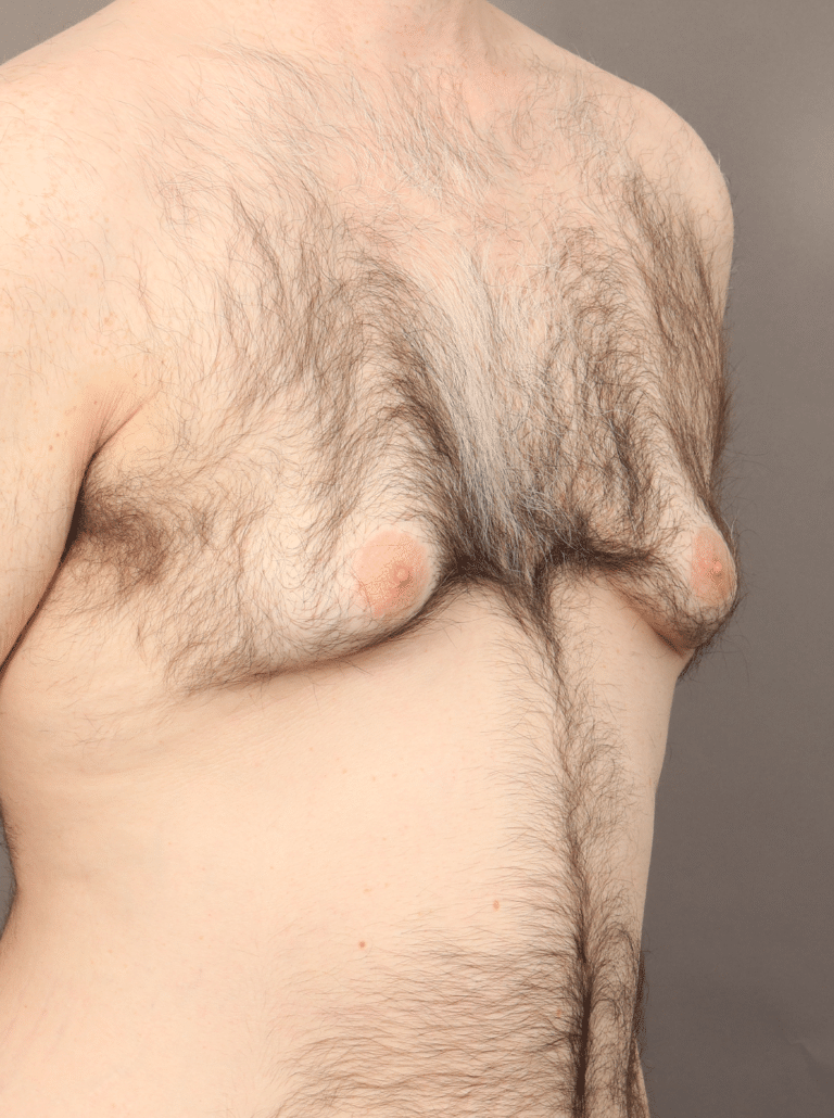 Before Image: Gynecomastia using VASER Liposuction & Renuvion Skin Tightening (6 Month Post-op) - right-front-oblique