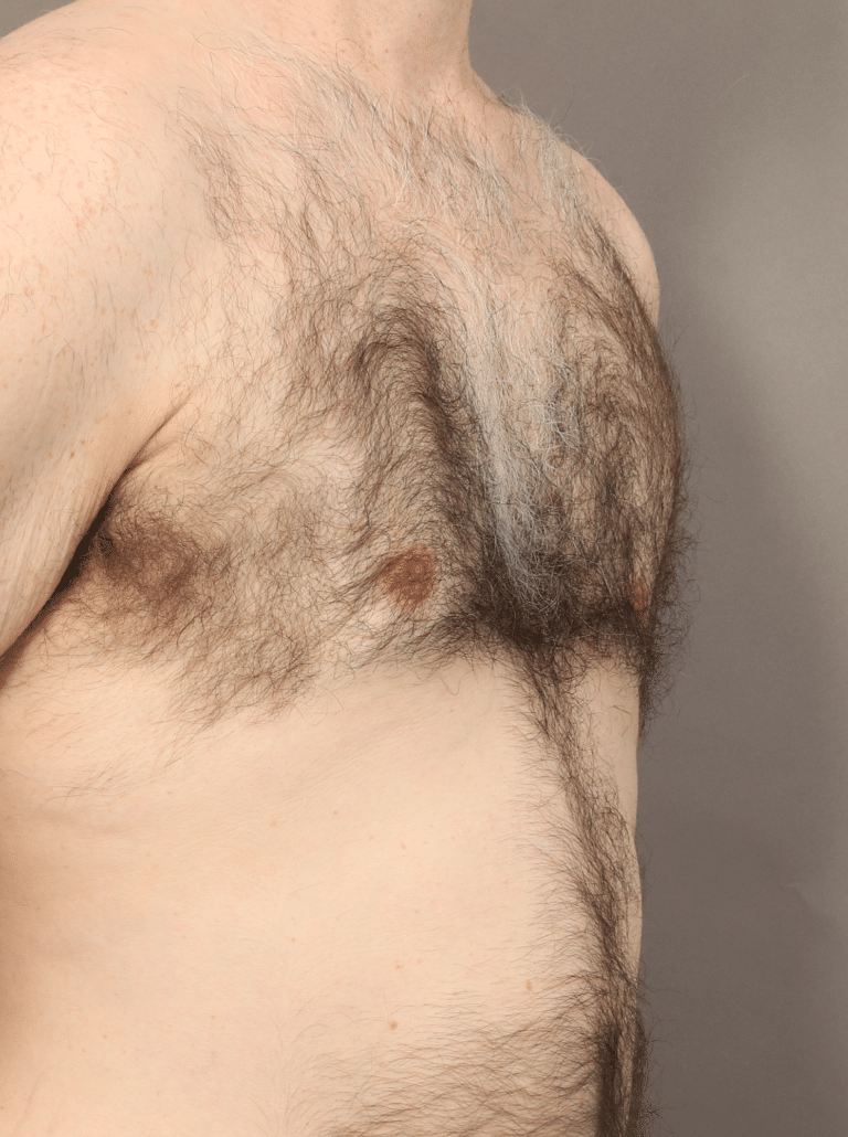 After Image: Gynecomastia using VASER Liposuction & Renuvion Skin Tightening (6 Month Post-op) - right-front-oblique