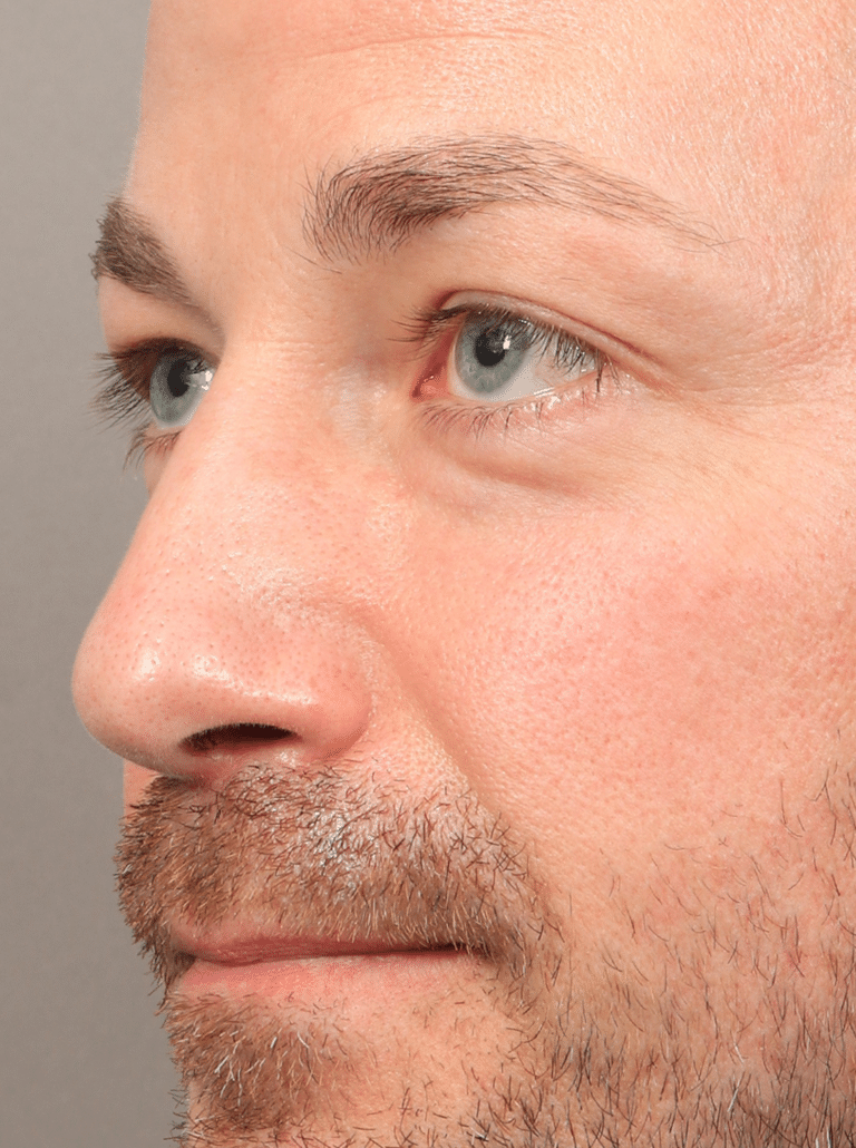 Before Image: Upper & Lower Eyelid Lift (4.5 Months Post-op) - left-front-oblique