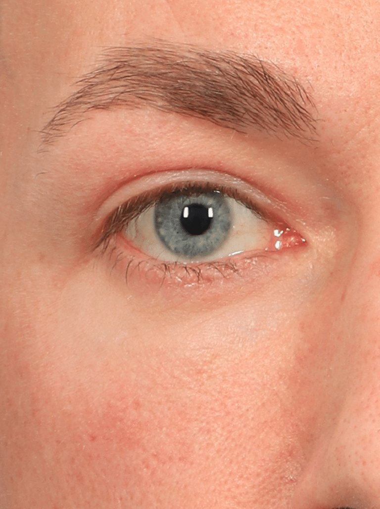 After Image: Upper & Lower Eyelid Lift (4.5 Months Post-op) - front