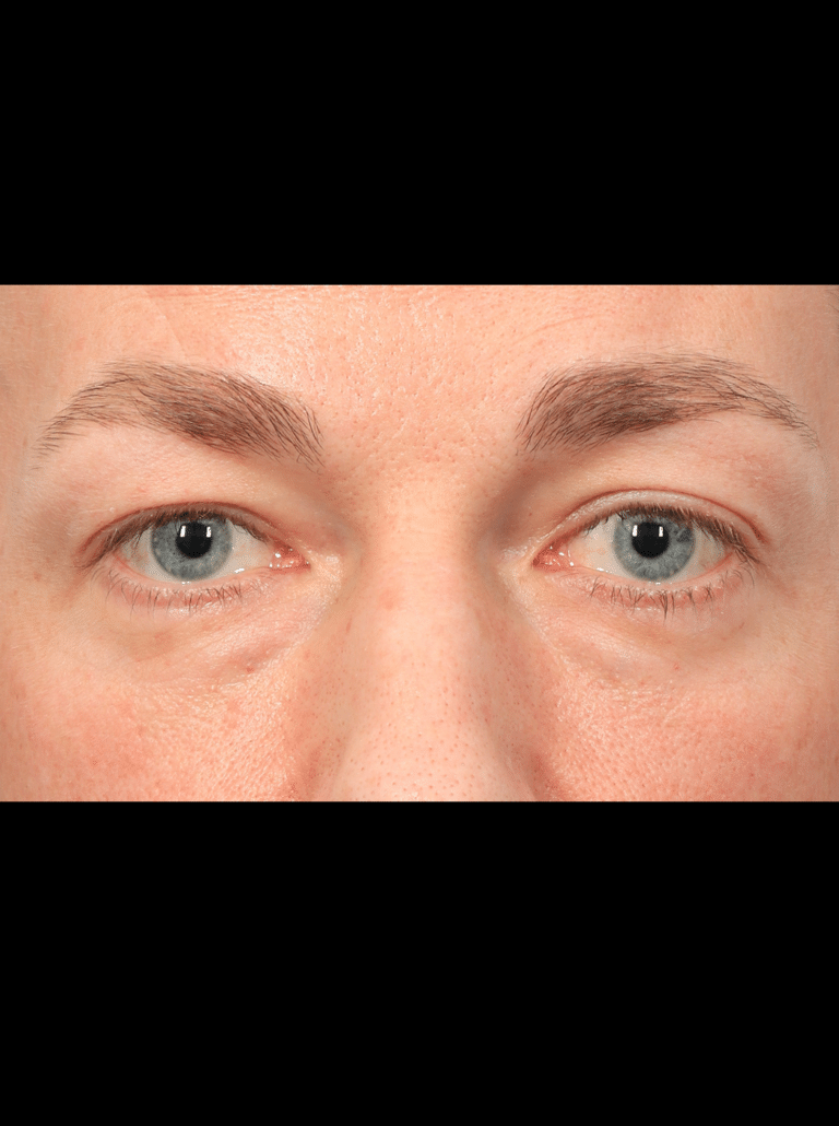 Before Image: Upper & Lower Eyelid Lift (4.5 Months Post-op) - front