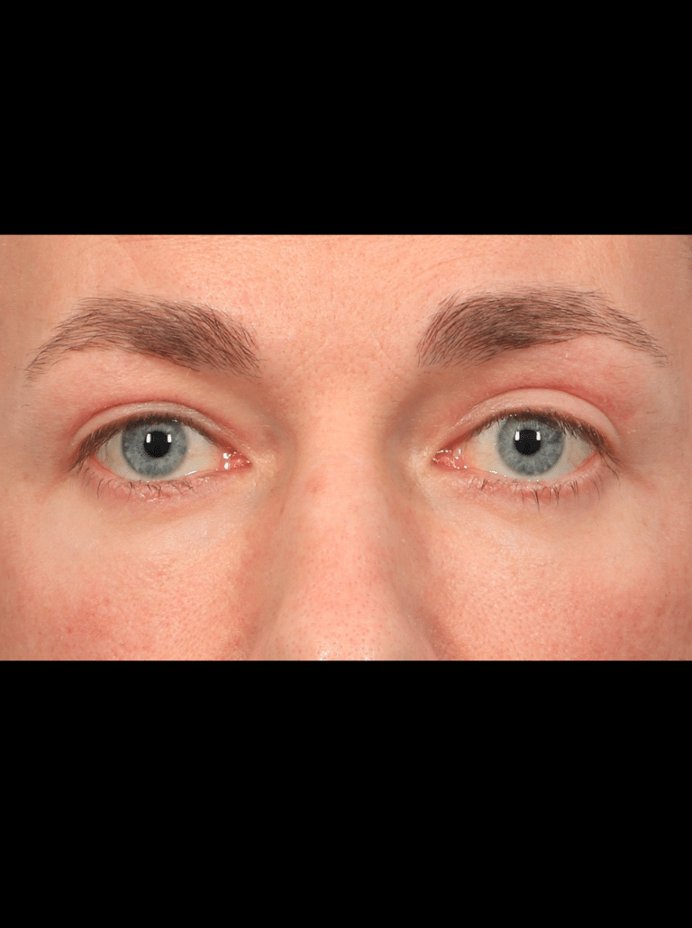 After Image: Upper & Lower Eyelid Lift (4.5 Months Post-op) - front