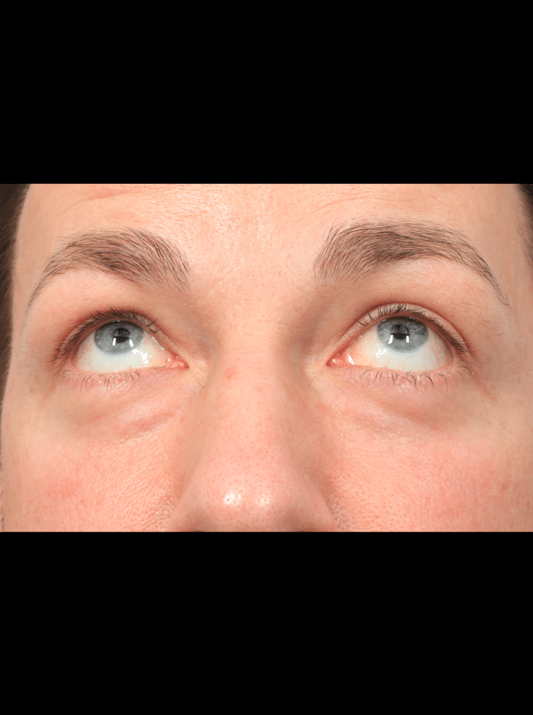 Before Image: Upper & Lower Eyelid Lift (4.5 Months Post-op) - front