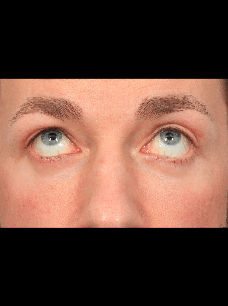 After Image: Upper & Lower Eyelid Lift (4.5 Months Post-op) - front