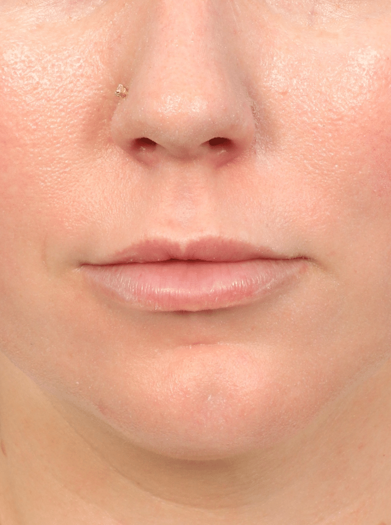 Before Image: Lip Lift (3 Months Post-op) - front