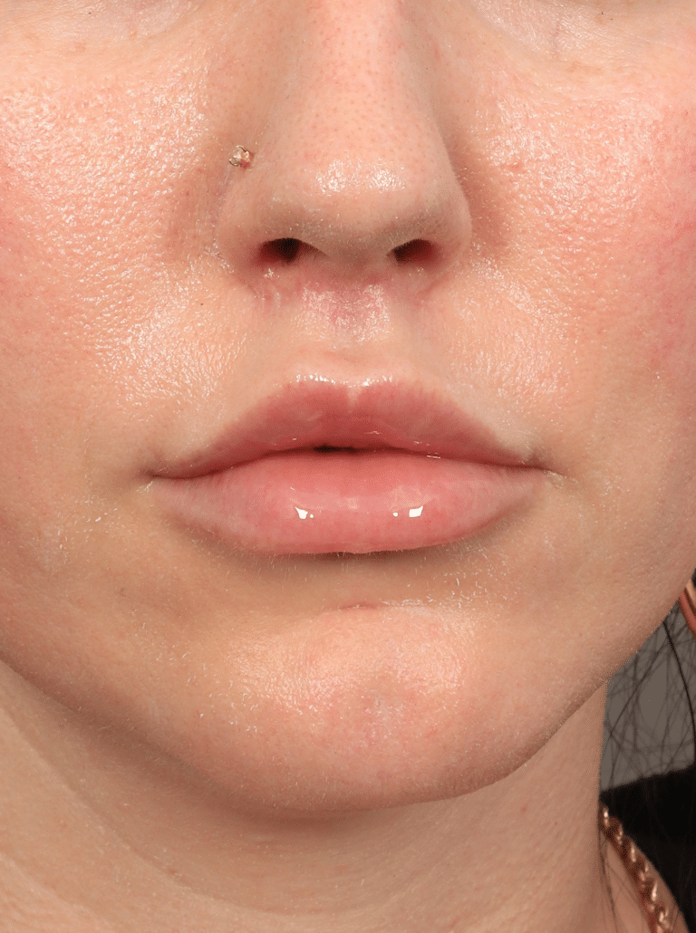 After Image: Lip Lift (3 Months Post-op) - front