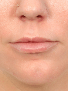 Before Image: Lip Lift (3 Months Post-op)