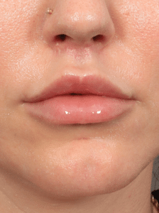 After Image: Lip Lift (3 Months Post-op)