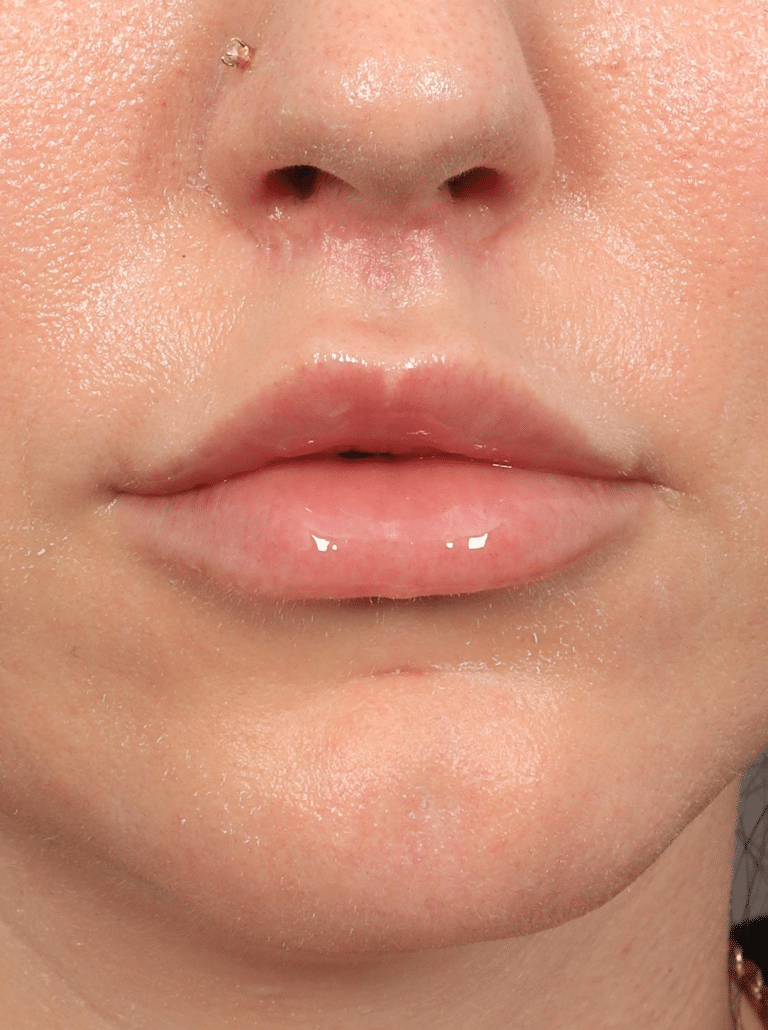 After Image: Lip Lift (3 Months Post-op) - front