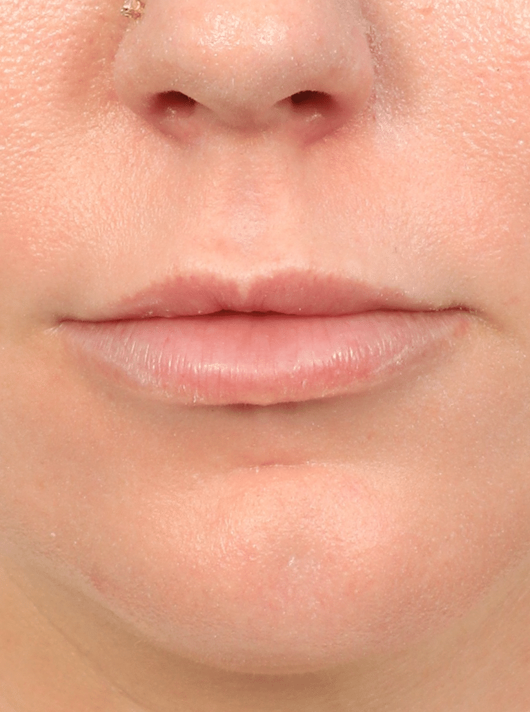 Before Image: Lip Lift (3 Months Post-op) - front