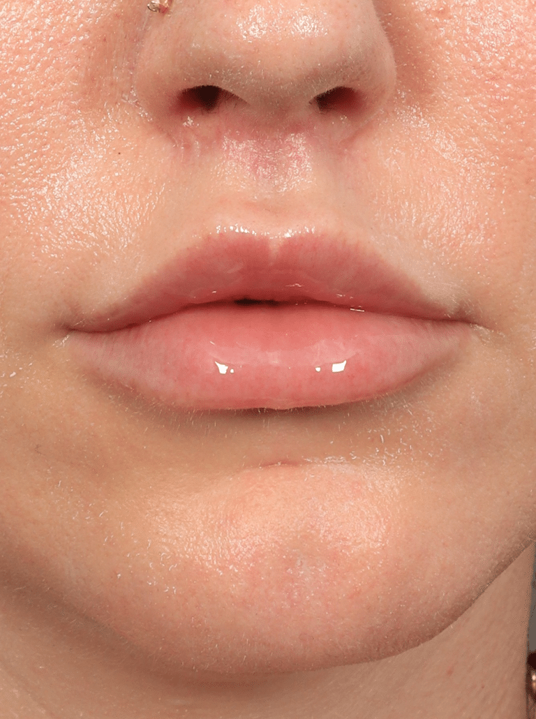 After Image: Lip Lift (3 Months Post-op) - front