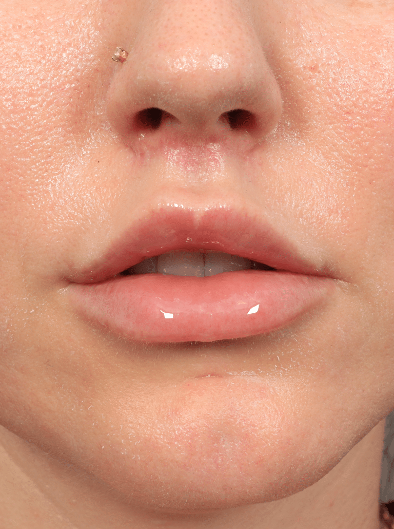 After Image: Lip Lift (3 Months Post-op) - front