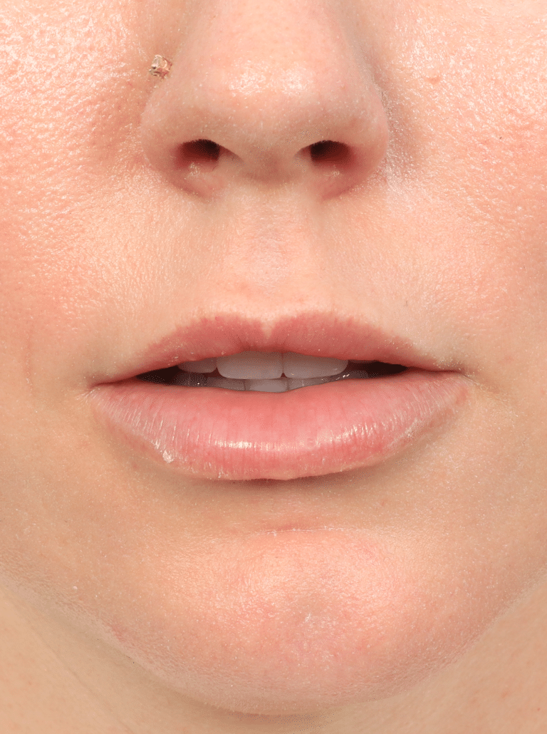 Before Image: Lip Lift (3 Months Post-op) - front