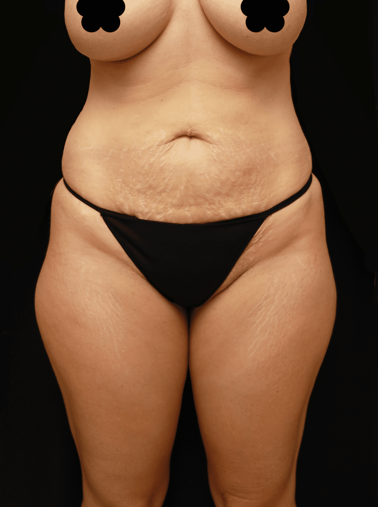 Before Image: Tummy Tuck, Liposuction, and Fat Grafting to Hips (6 Months Post-op) - front