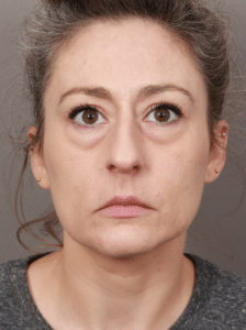 Before Image: Deep Plane Facelift and Neck Lift, Upper/Lower Blepharoplasty (Eyelid Lift), Buccal Fat Removal, Temporal Brow Lift, Fat Grafting, and CO2 Laser Resurfacing (1 Year Post-op)