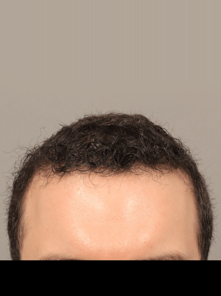 After Image: NeoGraft Hair Transplant - front