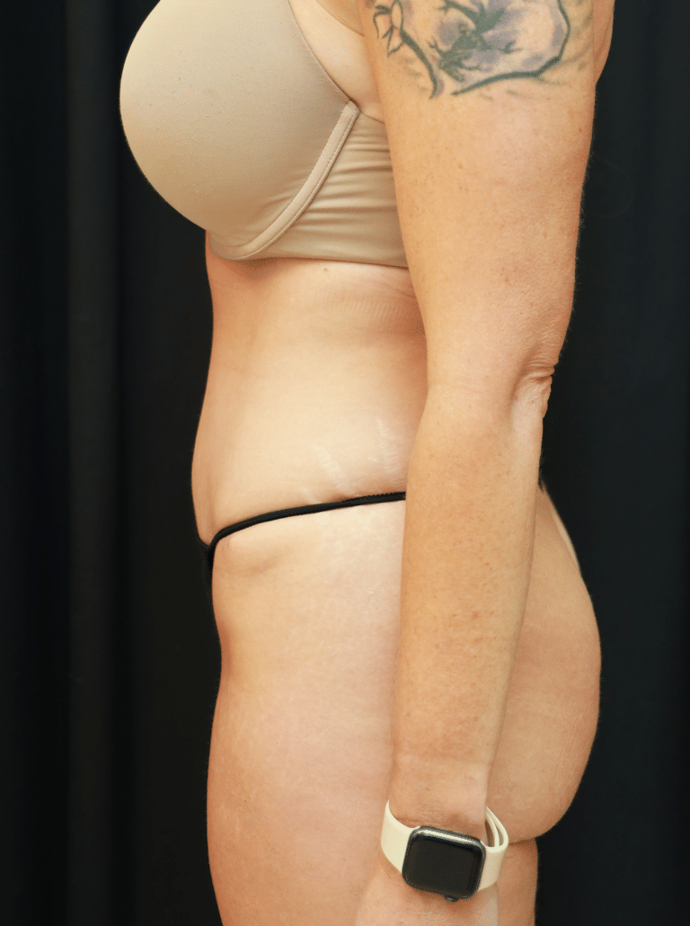 After Image: Tummy Tuck, Liposuction, and Fat Grafting to Hips (6 Months Post-op) - left-side