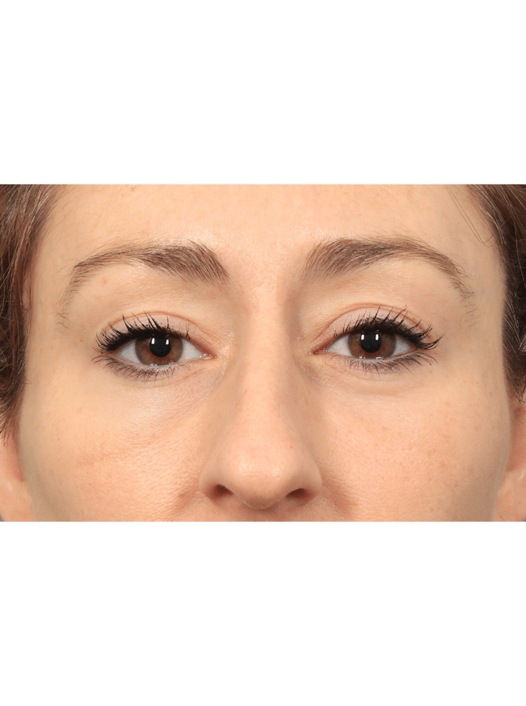 After Image: Upper/Lower Blepharoplasty (Eyelid Lift), Brow Lift, Deep Plane Facelift and Neck Lift, Buccal Fat Removal, Fat Grafting, and CO2 Laser Resurfacing (1 Year Post-op) - front