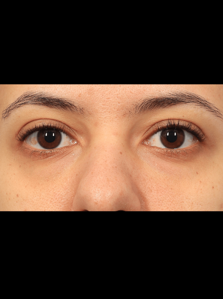 Before Image: Lower Blepharoplasty (3.5 Months Post-op) -