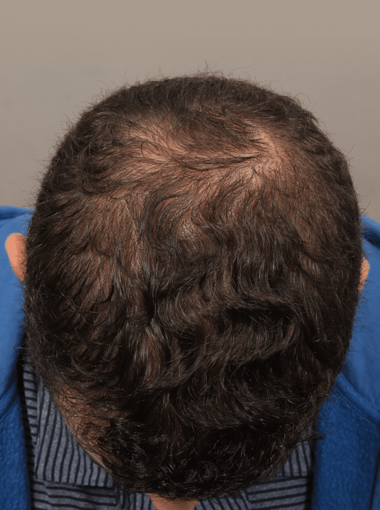 After Image: NeoGraft Hair Transplant - front