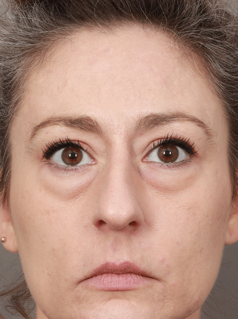 Before Image: Upper/Lower Blepharoplasty (Eyelid Lift), Brow Lift, Deep Plane Facelift and Neck Lift, Buccal Fat Removal, Fat Grafting, and CO2 Laser Resurfacing (1 Year Post-op) - front