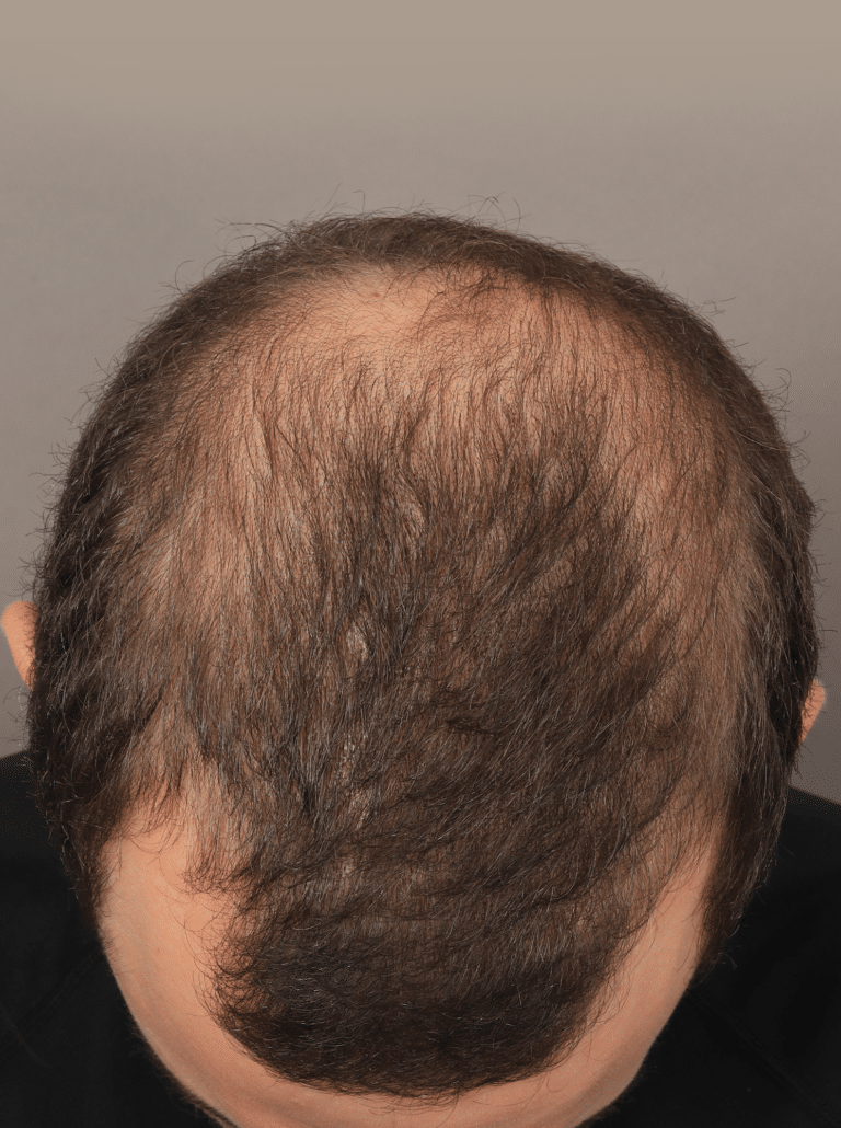 Before Image: NeoGraft Hair Transplant - front