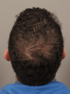 After Image: NeoGraft Hair Transplant