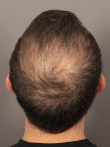 Before Image: NeoGraft Hair Transplant