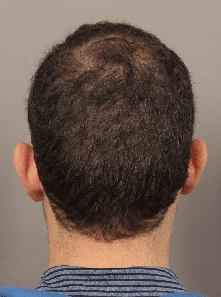 After Image: NeoGraft Hair Transplant - back