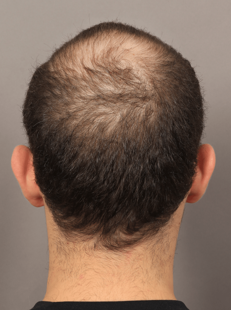 Before Image: NeoGraft Hair Transplant - back