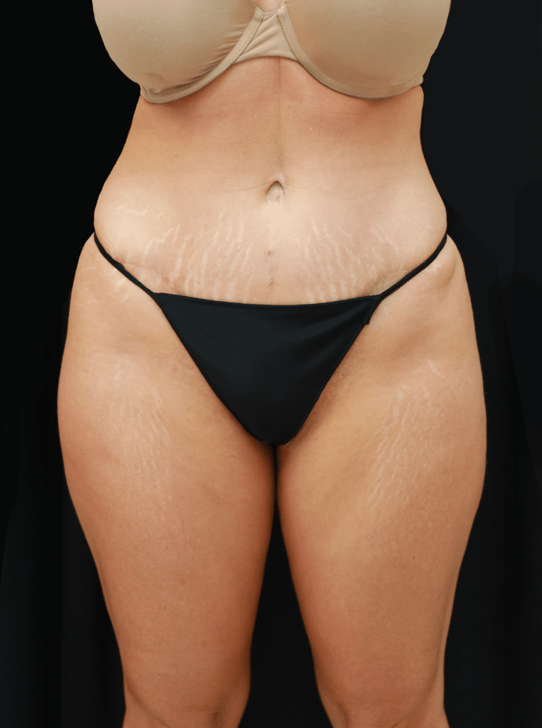 After Image: Tummy Tuck, Liposuction, and Fat Grafting to Hips (6 Months Post-op) - front