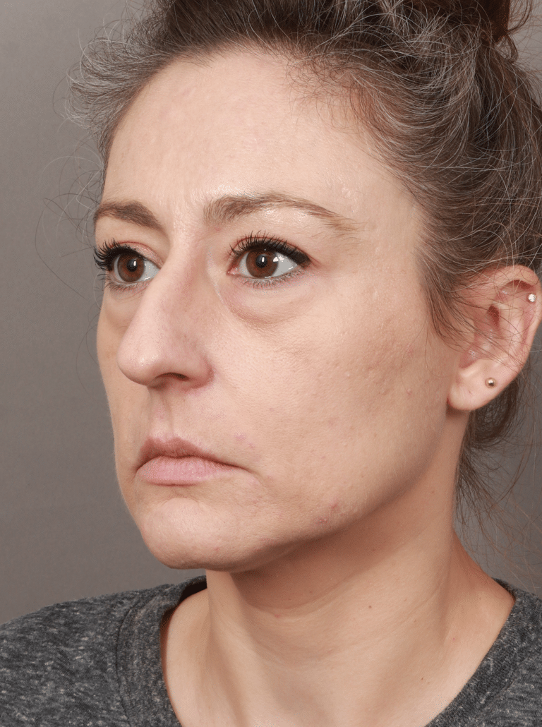 Before Image: Upper/Lower Blepharoplasty (Eyelid Lift), Brow Lift, Deep Plane Facelift and Neck Lift, Buccal Fat Removal, Fat Grafting, and CO2 Laser Resurfacing (1 Year Post-op) - left-front-oblique