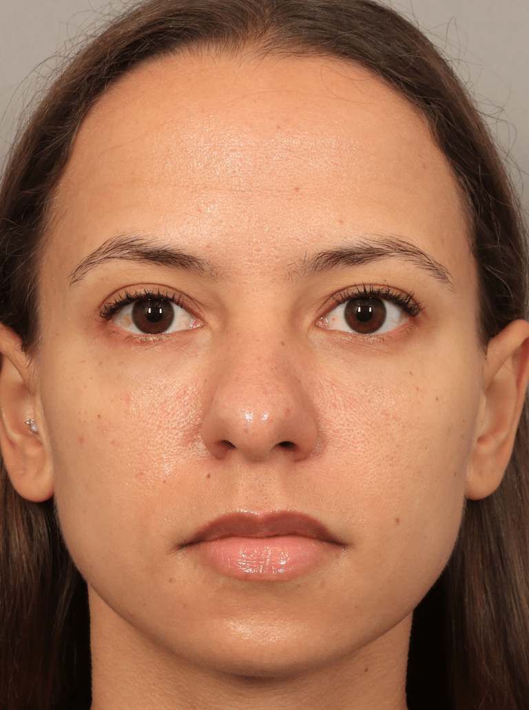 After Image: Lower Blepharoplasty (3.5 Months Post-op) - front