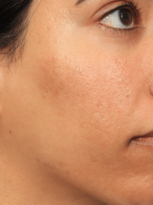 After Image: Acne Scar Treatment (Fat Grafting, Filler, Microneedling, & Chemical Peels)