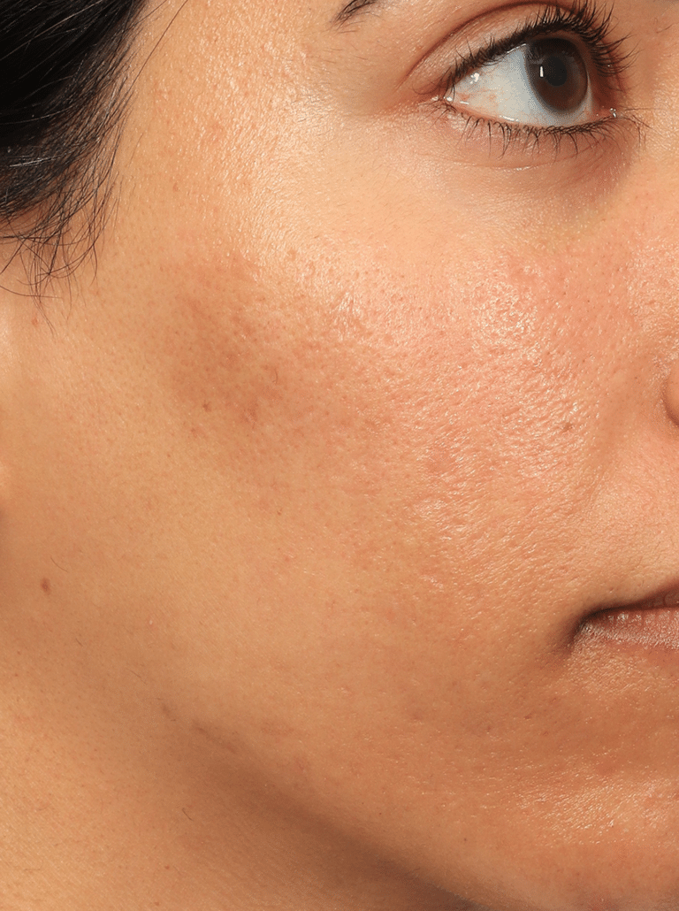 After Image: Acne Scar Treatment (Fat Grafting, Filler, Microneedling, & Chemical Peels) - right-side