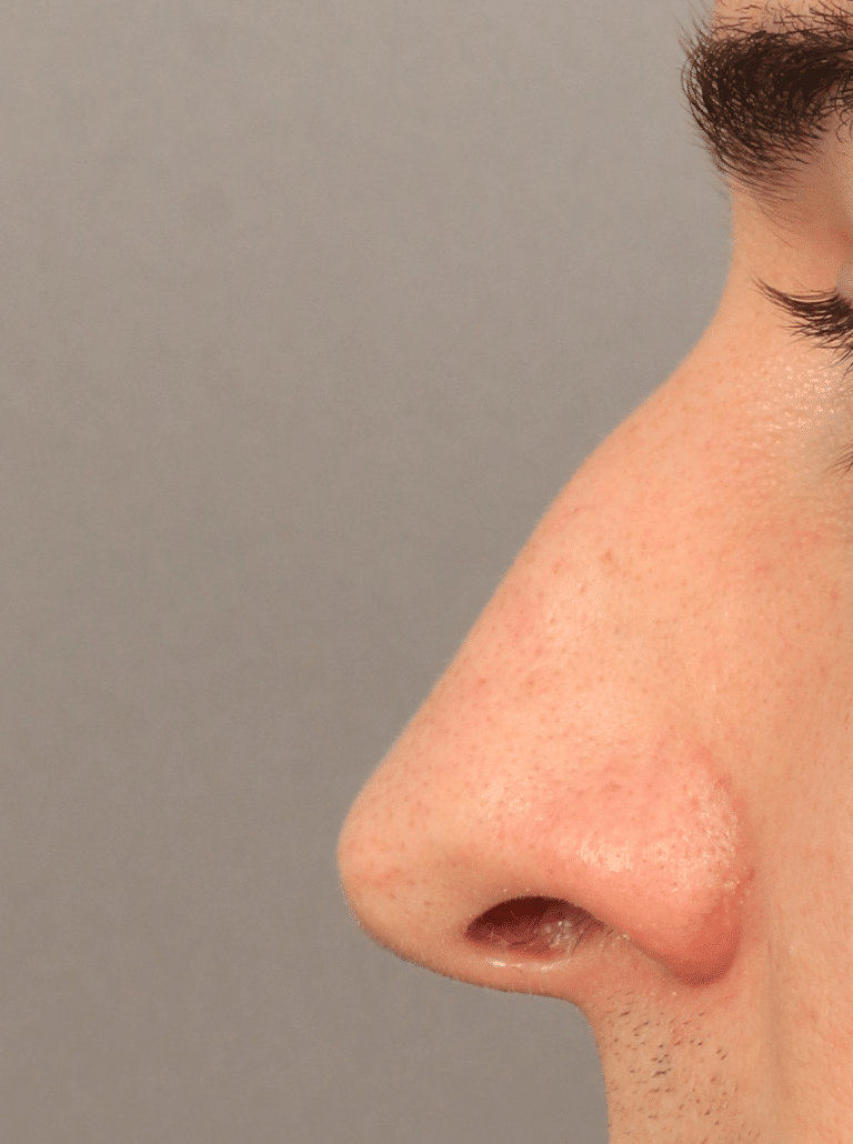 Before Image: Rhinoplasty, Septoplasty, and Alarplasty (4.5 Months Post-op) -