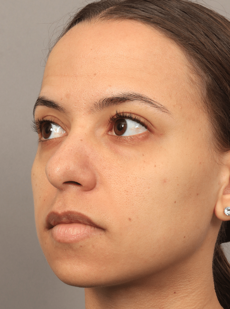 Before Image: Lower Blepharoplasty (3.5 Months Post-op) - left-front-oblique